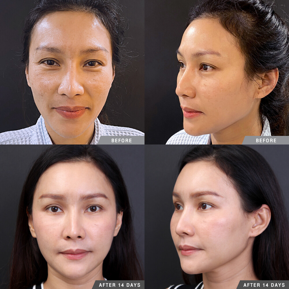 Before and After Result